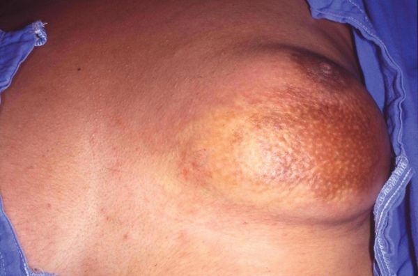 Посттравматические изменения груди: от ушиба до диагностики и лечения