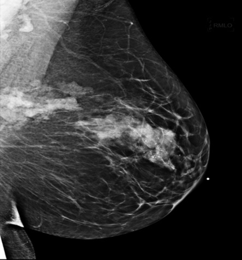Аденоз молочной железы: полное руководство по диагностике и лечению заболевания