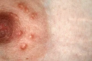 Железы Монтгомери на сосках: полное руководство по норме и патологиям