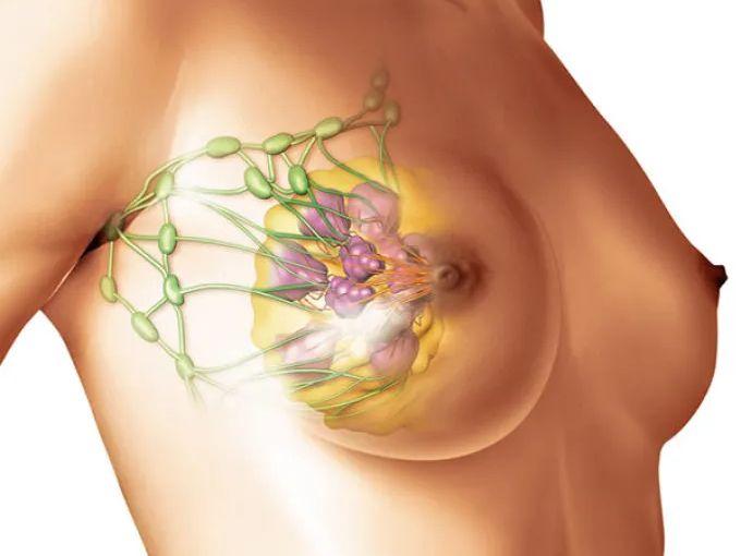 Доброкачественная дисплазия молочной железы: ваш полный гид по здоровью груди