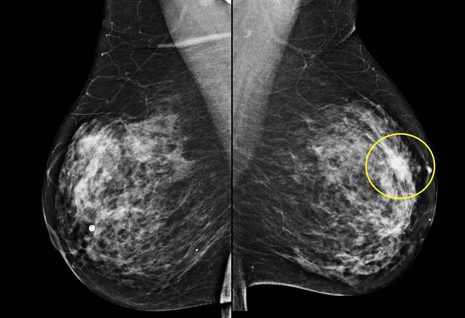 Узловая мастопатия: полное руководство по диагностике, лечению и прогнозу