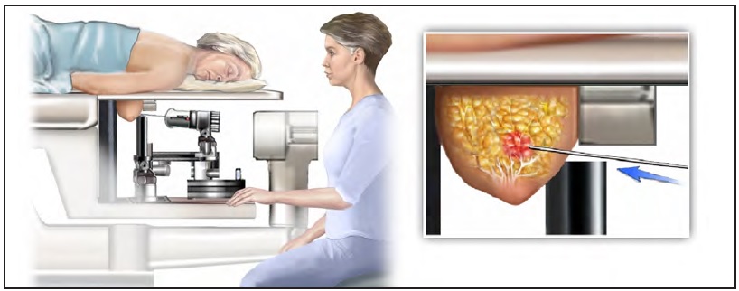Стереотаксическая биопсия молочной железы для точной диагностики новообразований