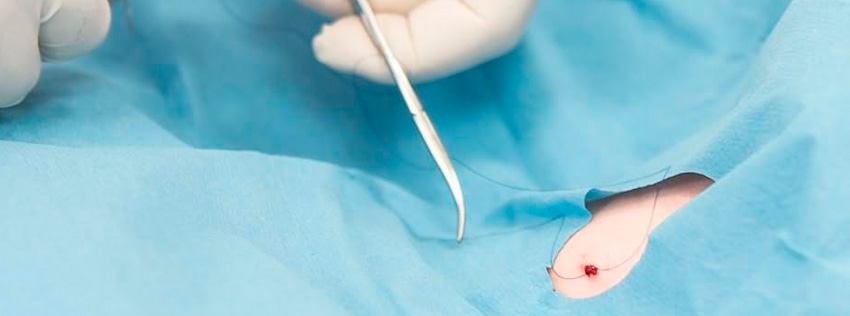 Подшивка от алкоголизма: как имплантация дисульфирама помогает начать трезвую жизнь