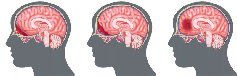 Субарахноидальное кровоизлияние: полное руководство по причинам и лечению