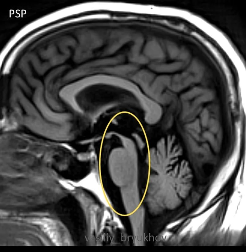 Прогрессирующий надъядерный паралич: полный гид по заболеванию для пациентов