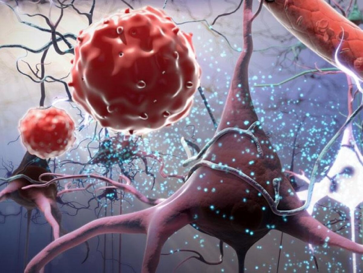 Кортикобазальная дегенерация: полное руководство по симптомам и лечению