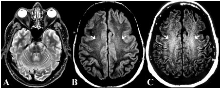 Мультисистемная атрофия: обретение контроля над симптомами и качеством жизни