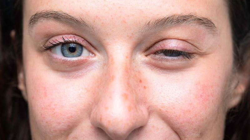 Миастения гравис: найти причину мышечной слабости и вернуть контроль над телом