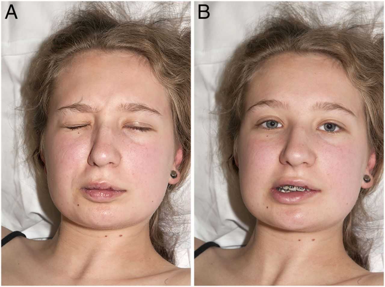 Синдром Гийена-Барре: обрести контроль над телом и вернуться к жизни