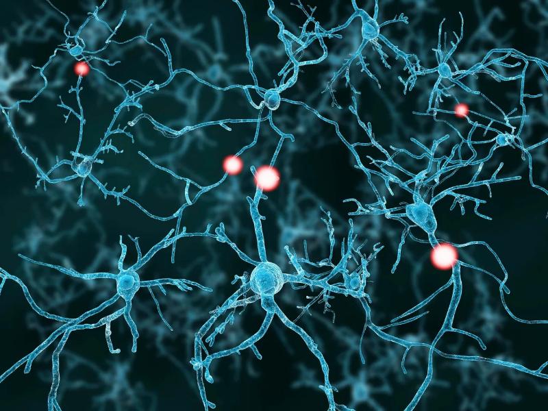 Хроническая воспалительная демиелинизирующая полинейропатия: руководство