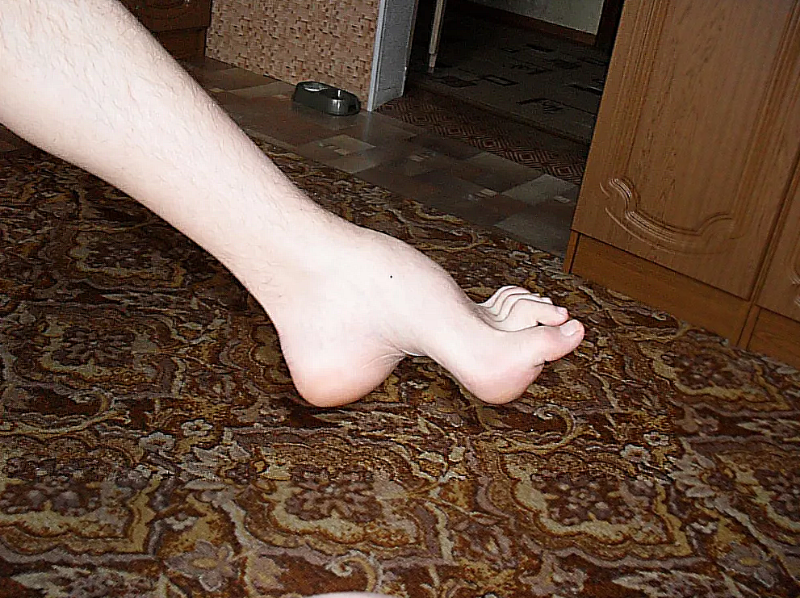 Болезнь Шарко-Мари-Тута у взрослых: полный обзор причин, симптомов и лечения