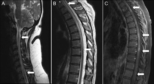 Оптиконевромиелит (болезнь Девика): полное руководство по симптомам и лечению