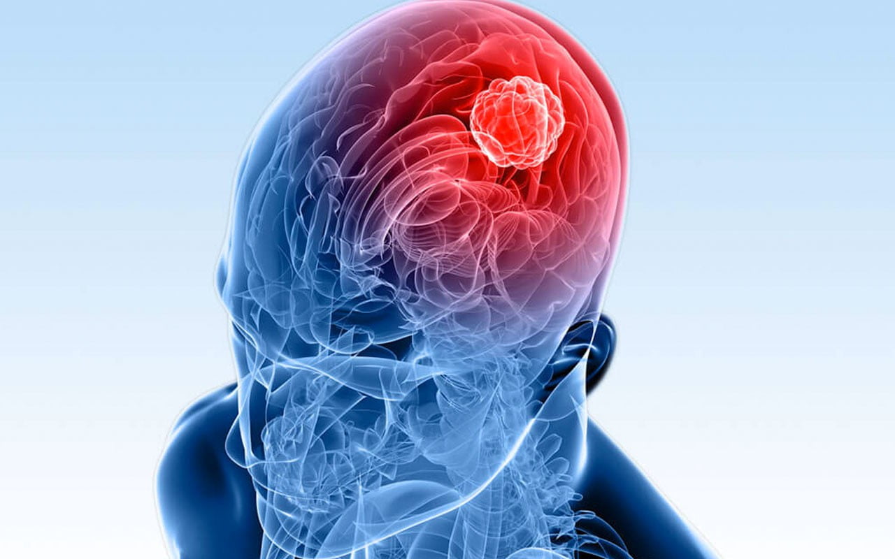 Энцефалит: полное руководство по причинам, симптомам и лечению воспаления мозга
