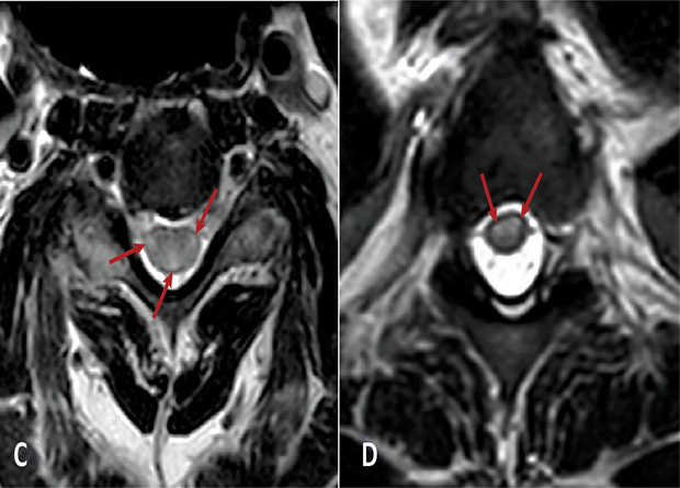 Миелит спинного мозга: причины, симптомы и современные подходы к лечению