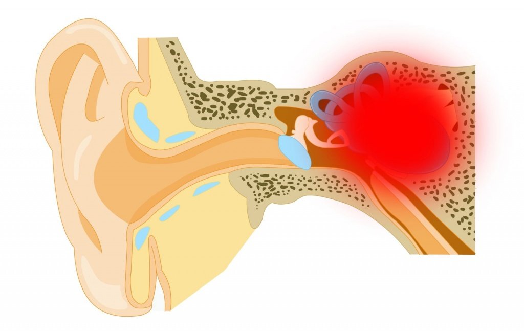 Болезнь Меньера: как вернуть контроль над равновесием и слухом