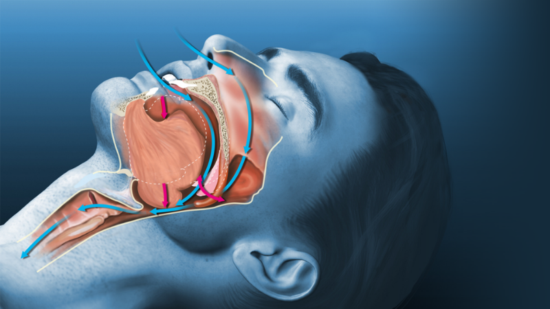 Центральное апноэ сна: найти причину и восстановить здоровый сон