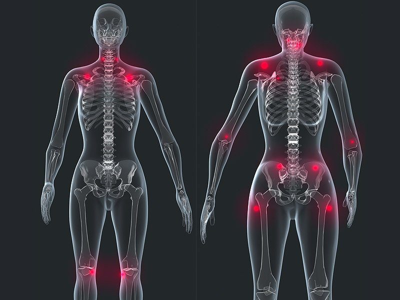 Фибромиалгия: полное руководство по управлению хронической болью и усталостью