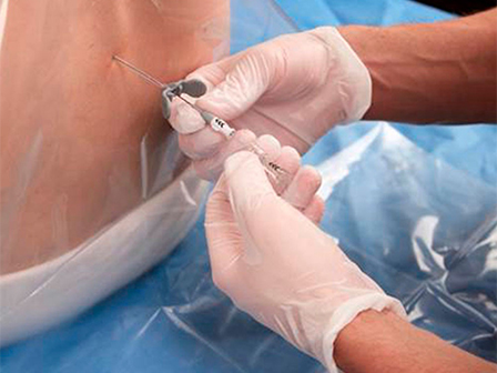 Люмбальная пункция: полное руководство по процедуре, показаниям и восстановлению