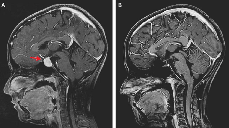 Аденома гипофиза: полное руководство по диагностике, лечению и прогнозу