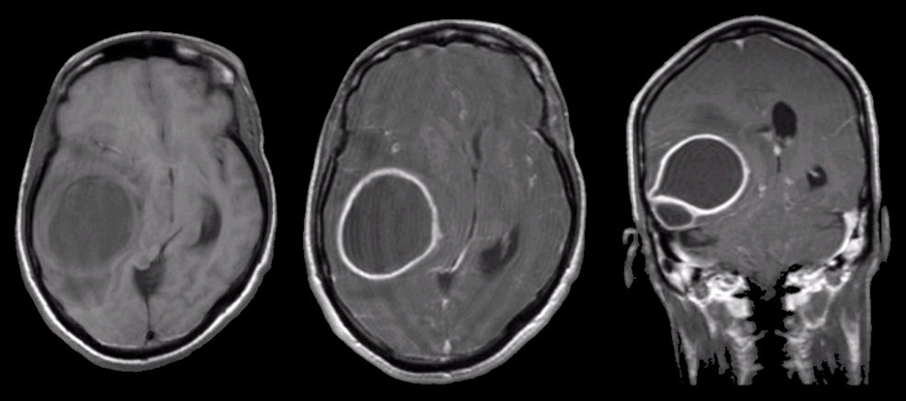 Абсцесс головного мозга: от точной диагностики до полного выздоровления