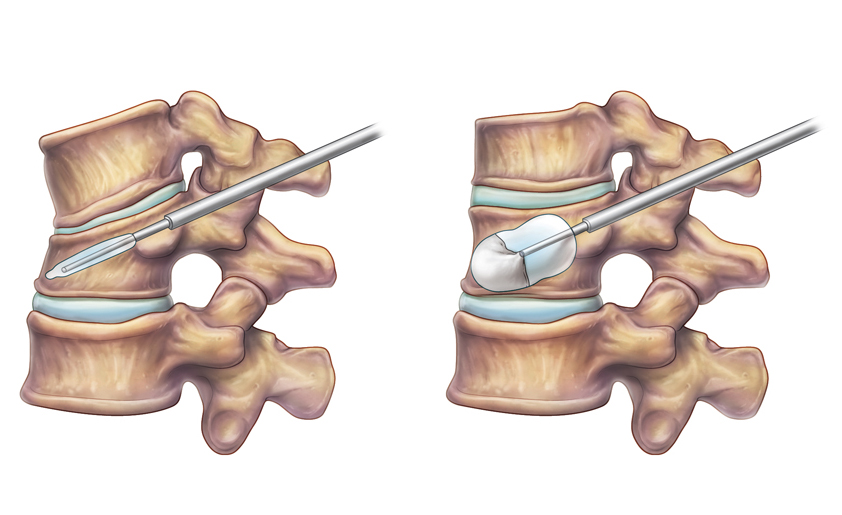 Вертебропластика позвоночника: восстановление после компрессионного перелома
