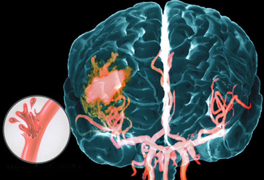 Внутримозговое кровоизлияние: от причин до современной нейрохирургии
