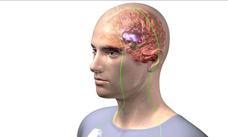 Глубокая стимуляция мозга (DBS): полный гид по возвращению контроля над телом
