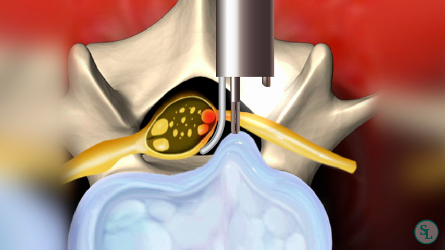 Дискэктомия: возвращение к активной жизни без боли в спине и ногах