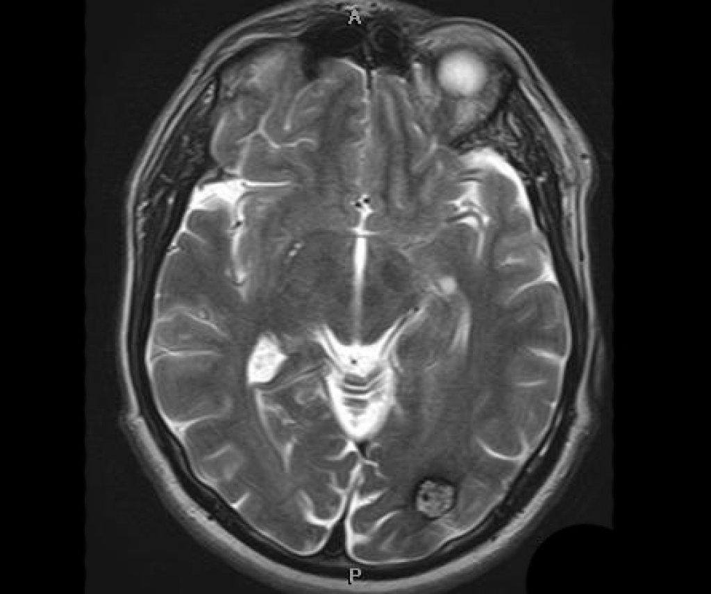 Кавернозная мальформация: полный гид по диагностике, лечению и прогнозу