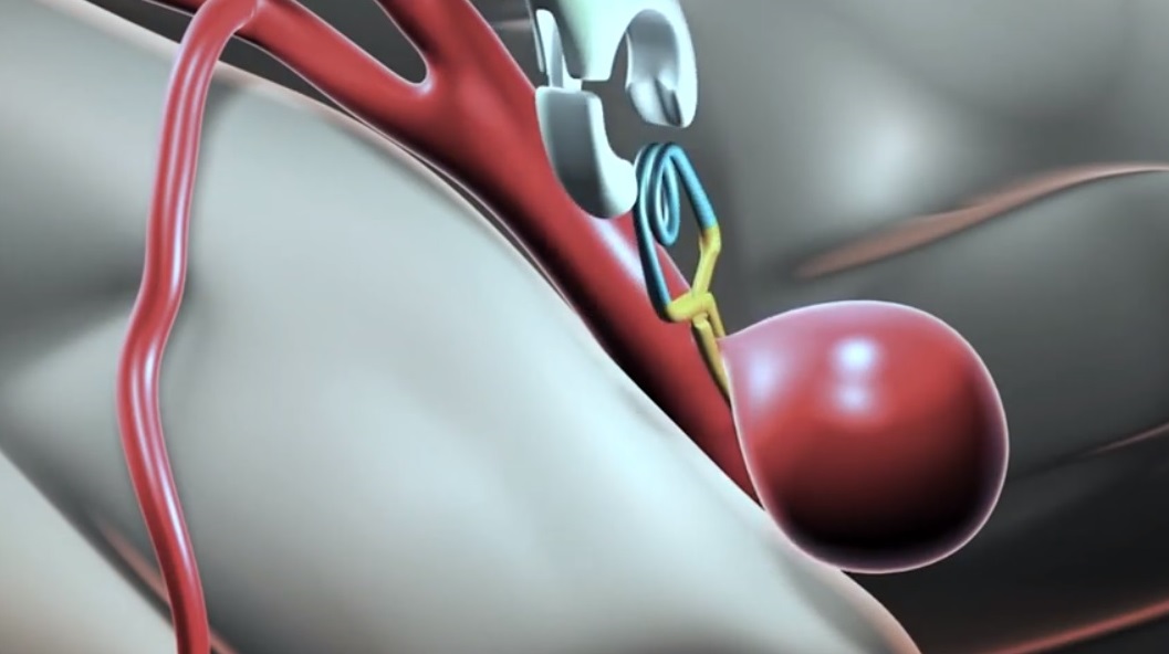 Клипирование аневризмы сосудов мозга: полное руководство для пациента