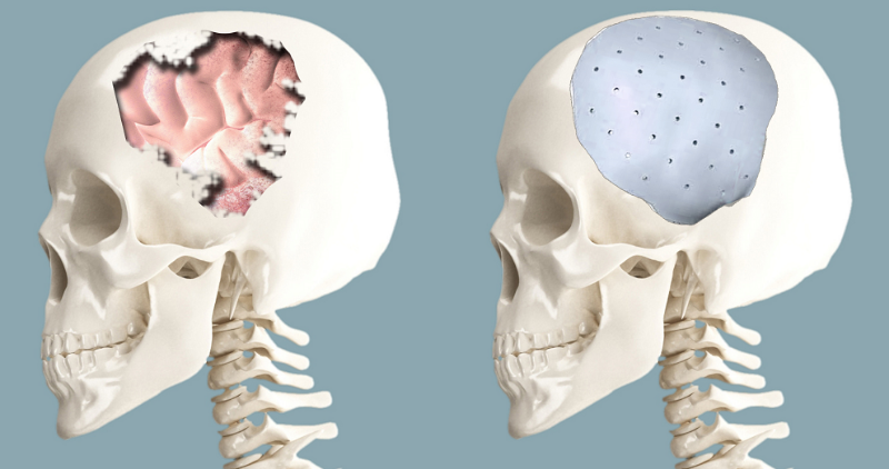 Краниопластика: восстановление черепа для защиты мозга и улучшения жизни