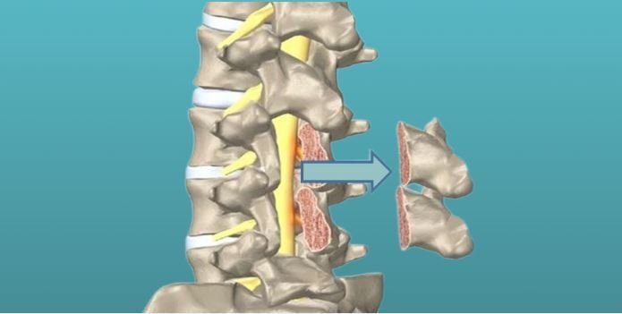 Ламинэктомия: полное руководство по операции для освобождения спинного мозга
