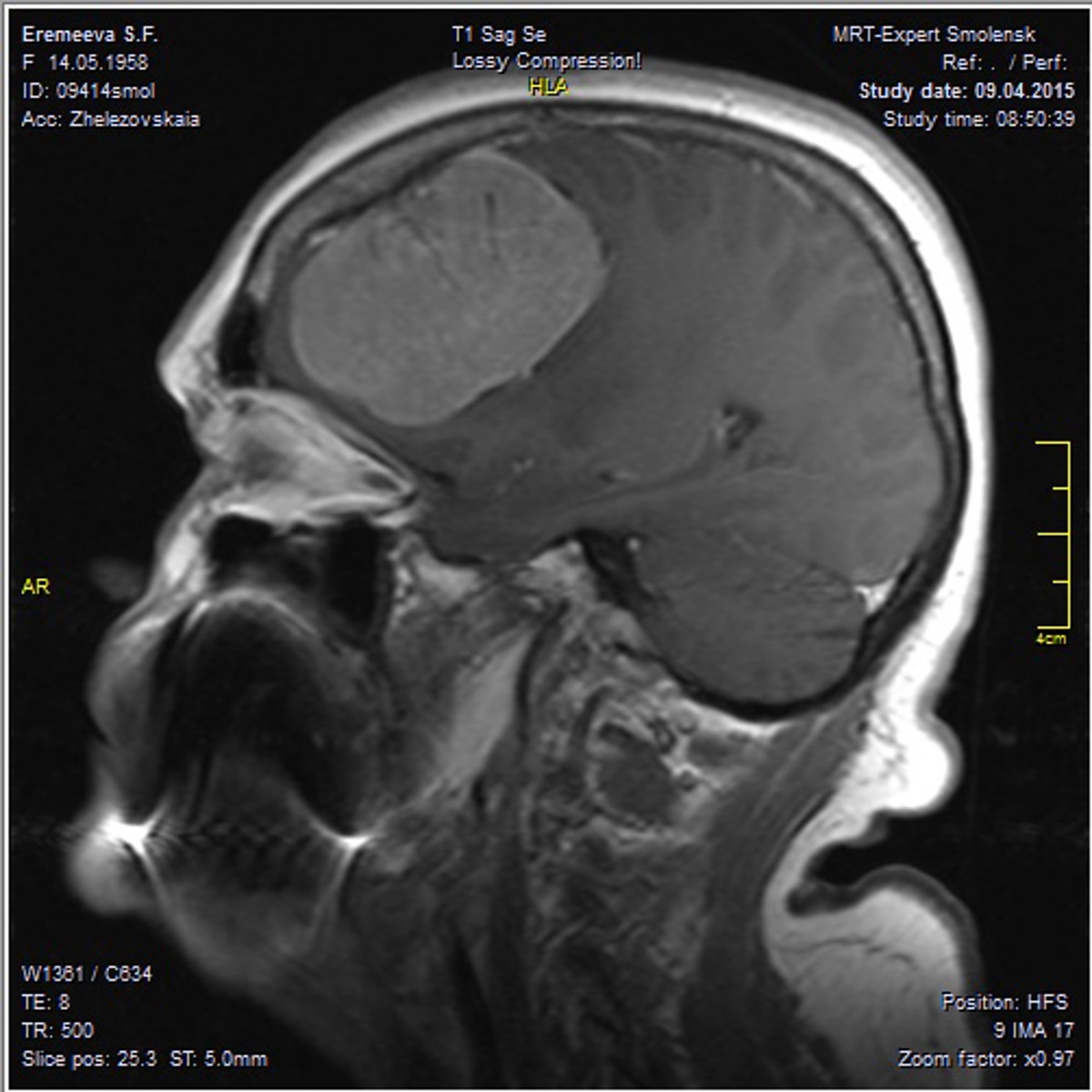 Менингиома: полное руководство по диагностике, лечению и прогнозу опухоли