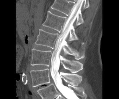Миелография: полное руководство по диагностике заболеваний позвоночника