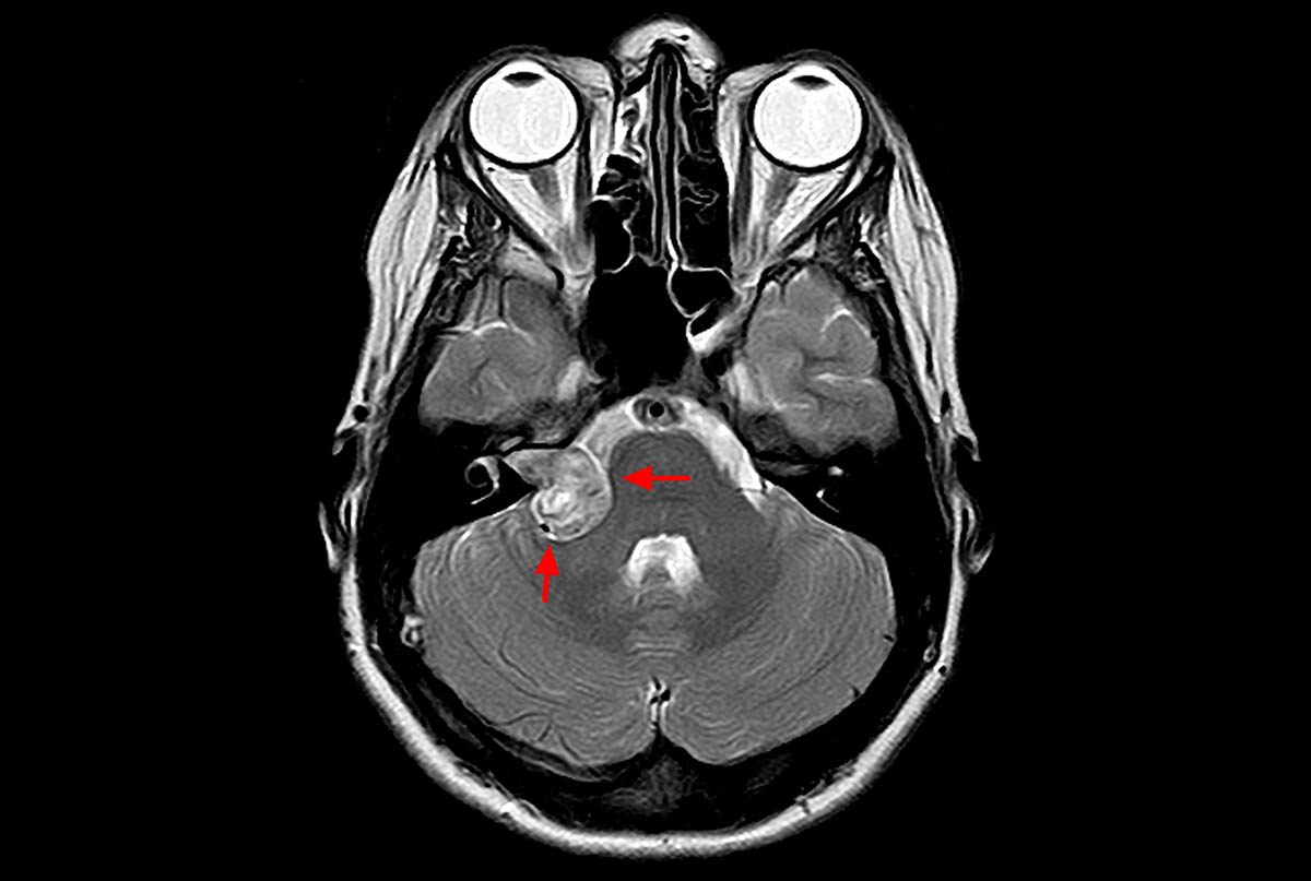 Невринома слухового нерва: полный путь от симптомов до полного выздоровления