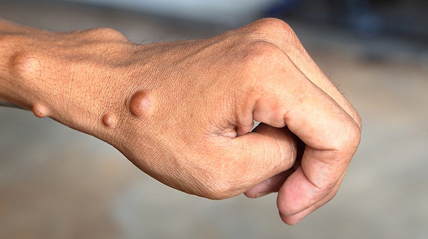 Нейрофиброматоз: полное руководство по современным методам диагностики и лечения