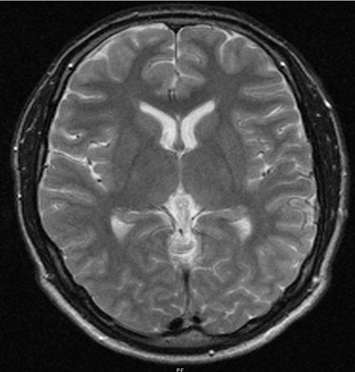 Нормотензивная гидроцефалия: вернуть контроль над движениями и ясность ума