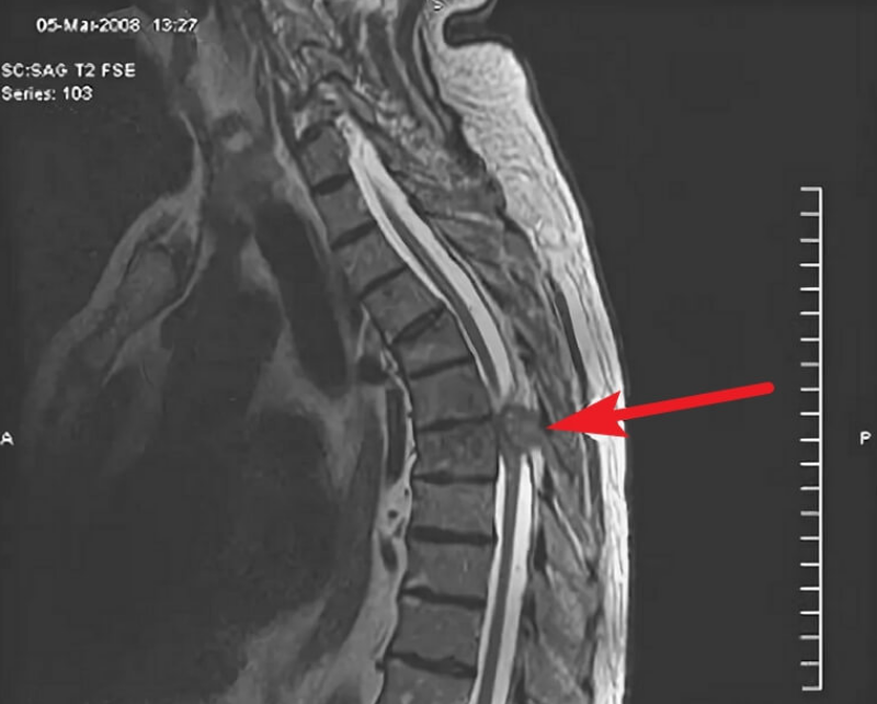 Опухоли спинного мозга: полное руководство по видам, симптомам и лечению