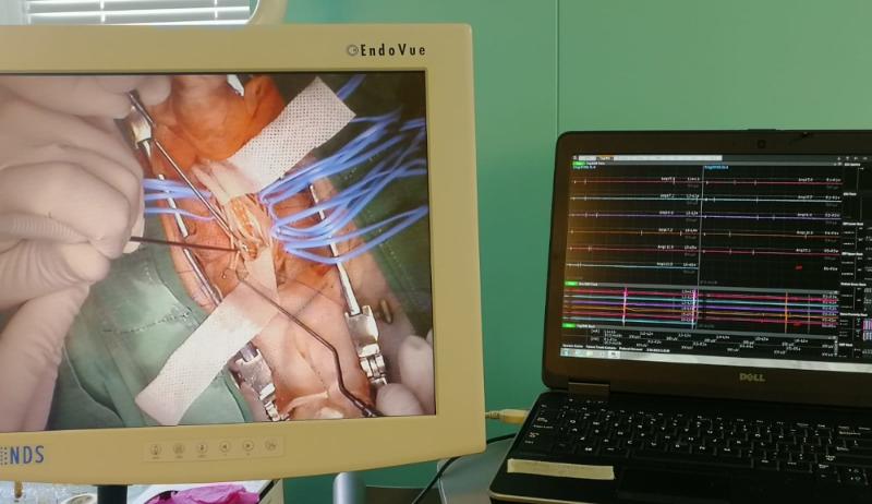 Селективная дорсальная ризотомия (СДР) для лечения спастичности при ДЦП