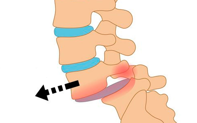 Спондилолистез позвоночника: обретение контроля над болью и движением