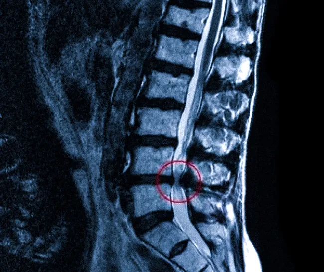 Стеноз позвоночного канала: полное руководство нейрохирурга по лечению