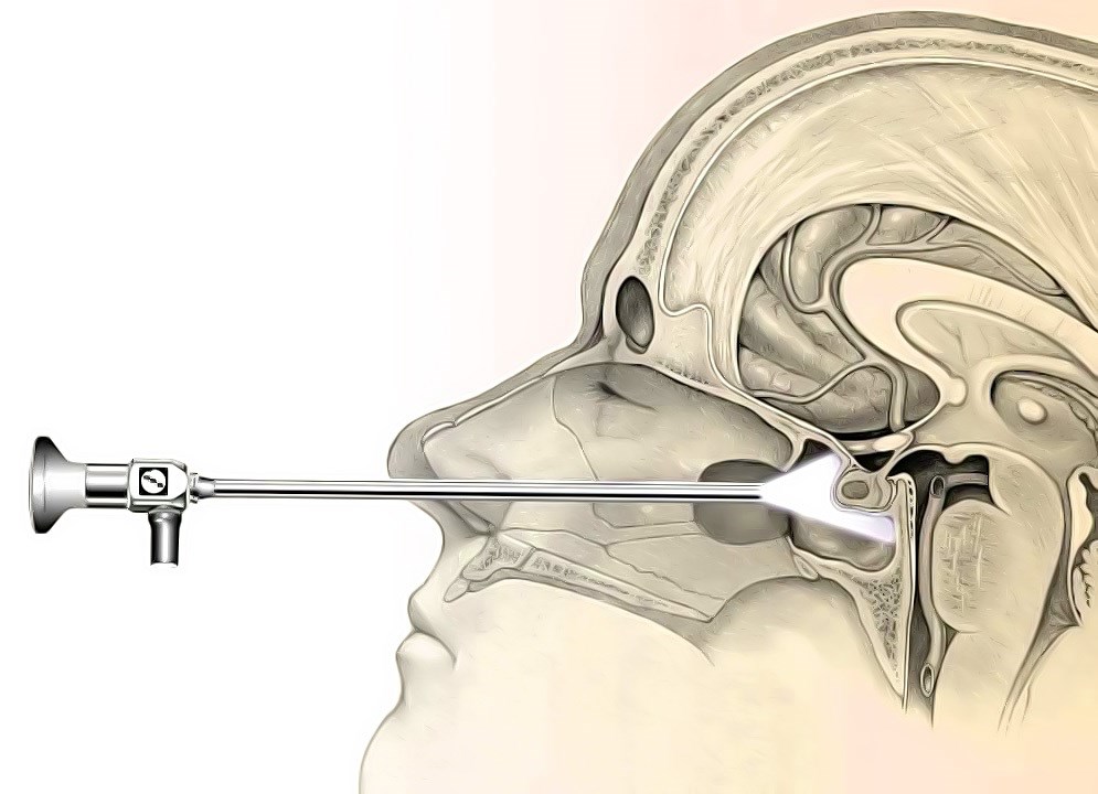 Транссфеноидальная хирургия: полное руководство по операции на гипофизе