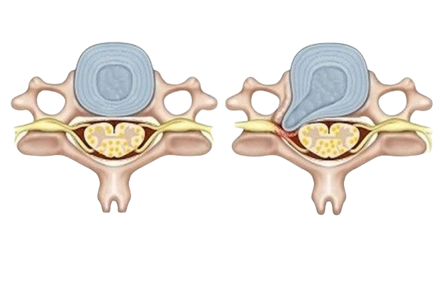Фораминотомия: полное руководство по операции для освобождения нерва