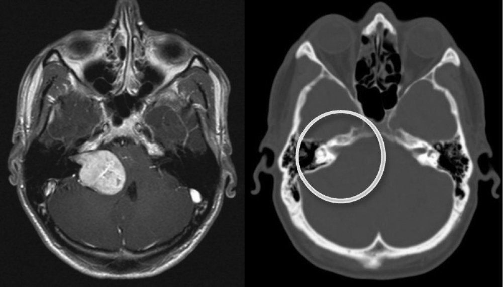 Шваннома: полное руководство по опухоли, диагностике и лечению