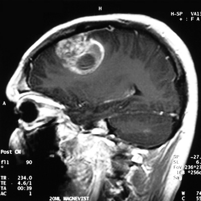 Астроцитома: ваш полный путеводитель по видам, лечению и прогнозам врачей