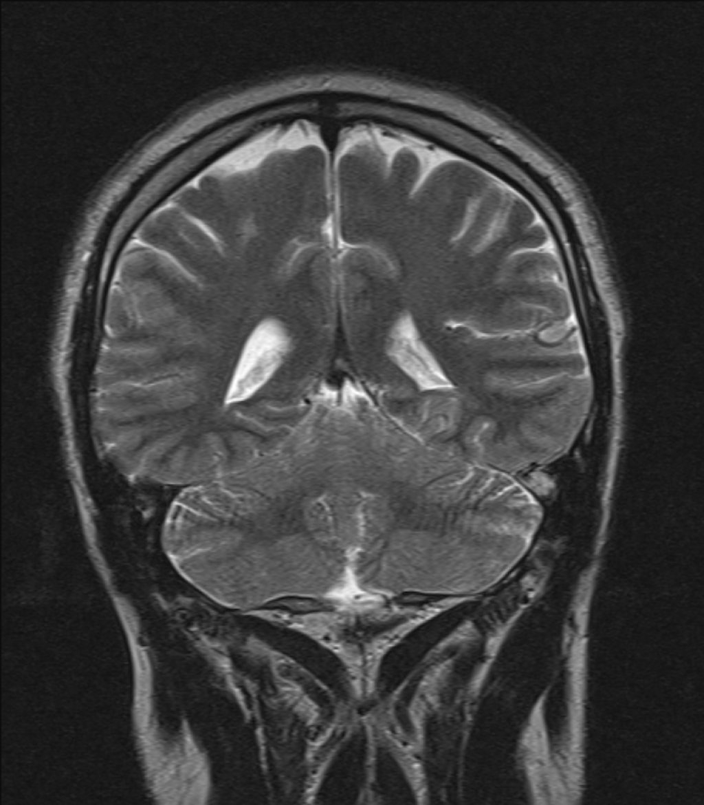 Эпендимома: полное руководство по диагностике, лечению и прогнозу выживаемости