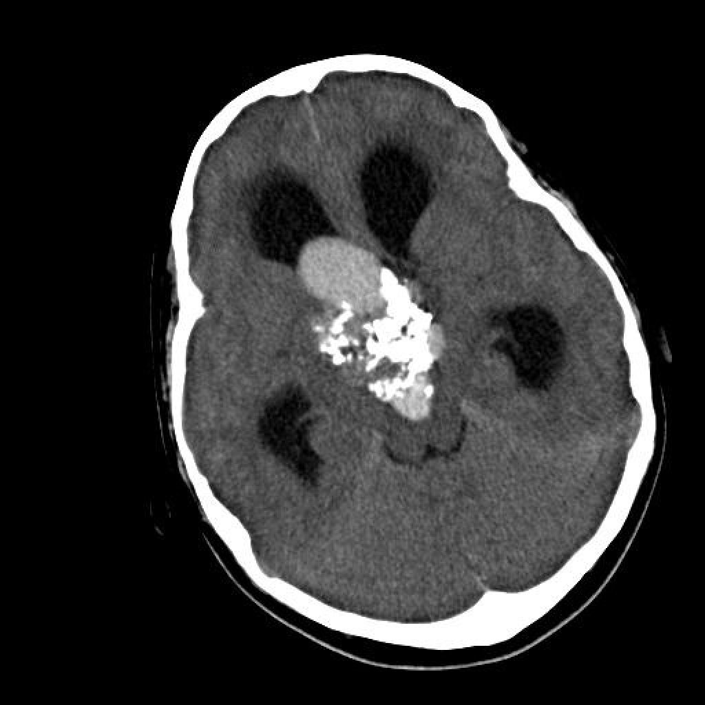 Краниофарингиома: полное руководство по диагностике и нейрохирургическому лечению