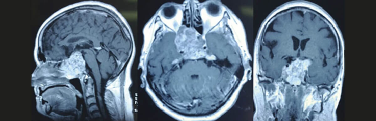 Хордома: полное руководство по редкой опухоли костей черепа и позвоночника