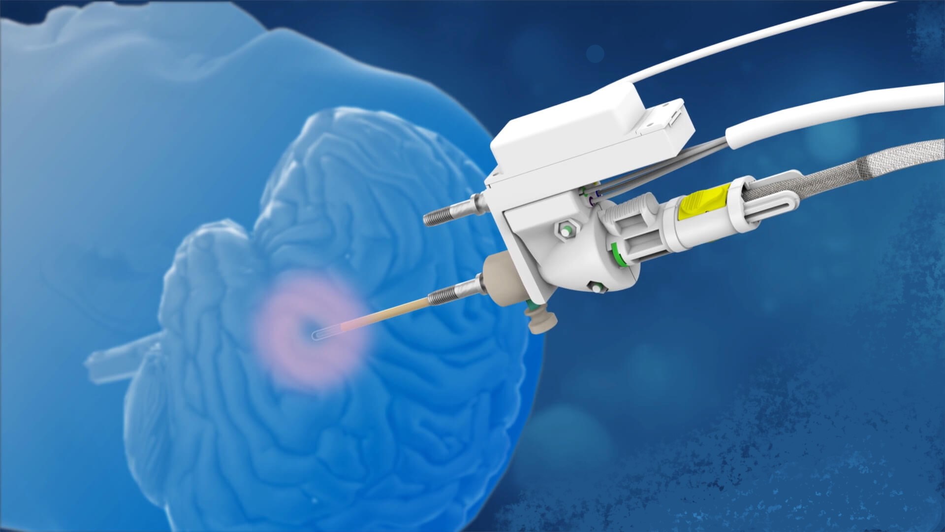 Лобэктомия при эпилепсии: полное руководство по операции и жизни после нее