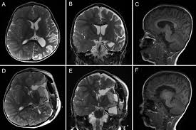 Функциональная гемисферэктомия: шанс на жизнь без приступов эпилепсии